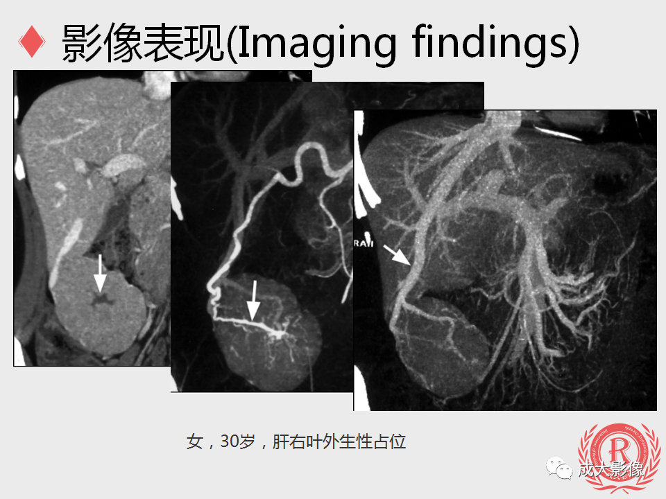 影像PPT - 【PPT】局灶性结节增生的影像表现-12
