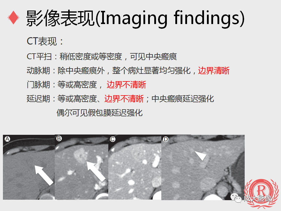 影像PPT - 【PPT】局灶性结节增生的影像表现-8
