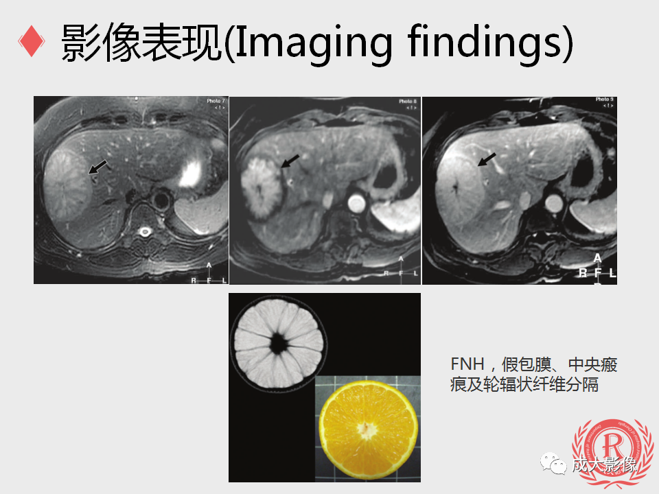 影像PPT - 【PPT】局灶性结节增生的影像表现-10