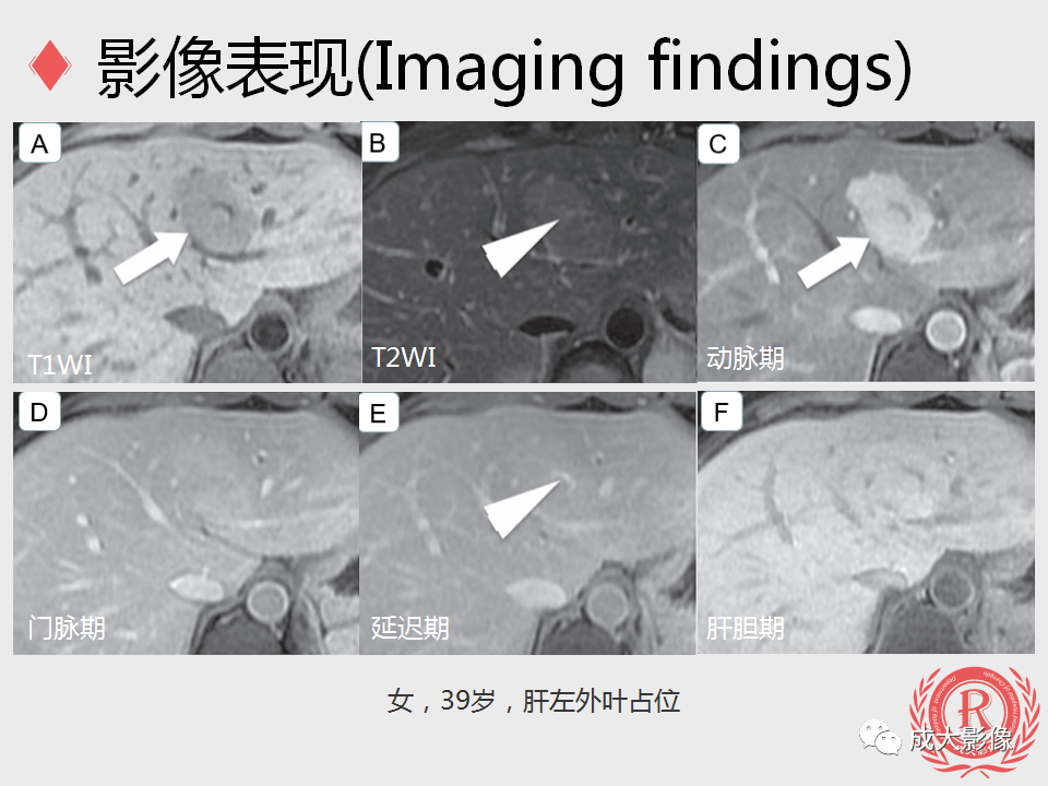 影像PPT - 【PPT】局灶性结节增生的影像表现-13