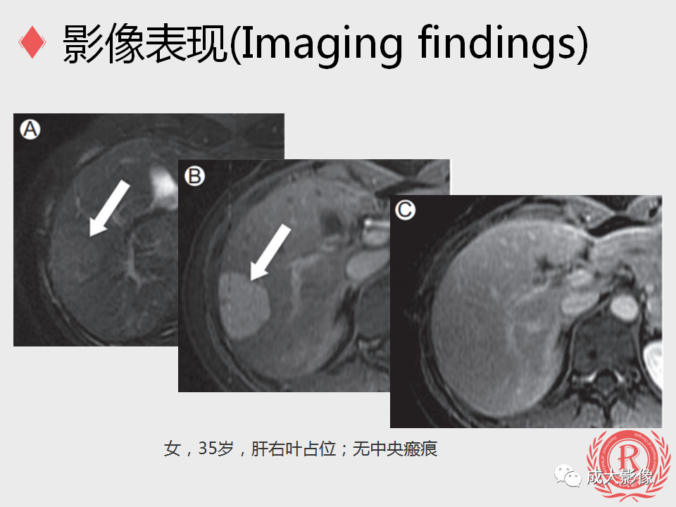 影像PPT - 【PPT】局灶性结节增生的影像表现-14