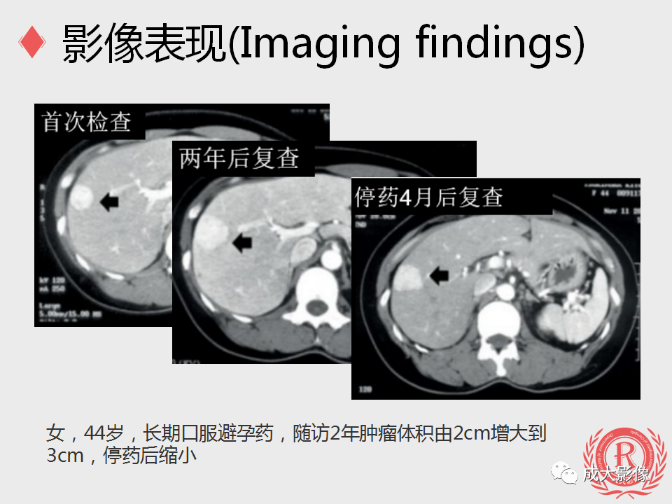 影像PPT - 【PPT】局灶性结节增生的影像表现-16