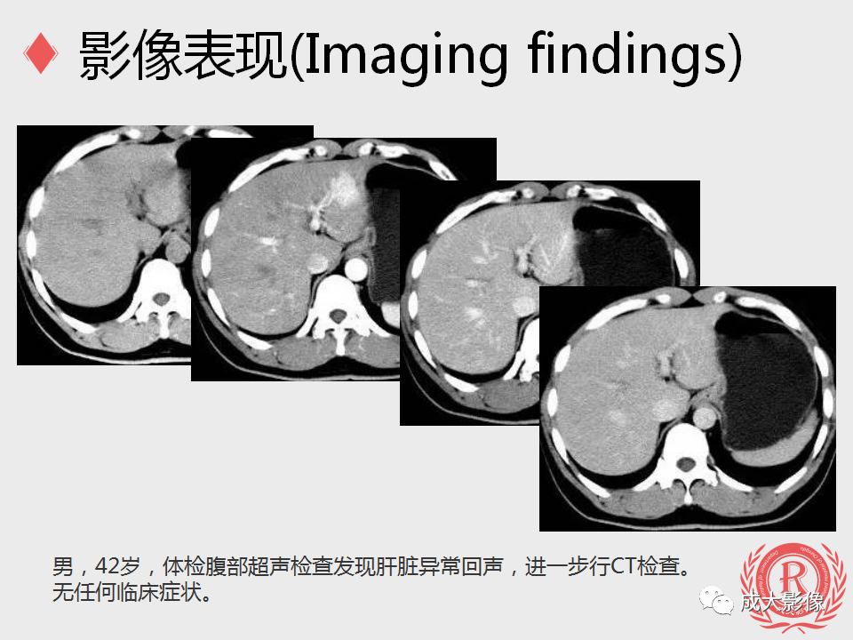 影像PPT - 【PPT】局灶性结节增生的影像表现-11