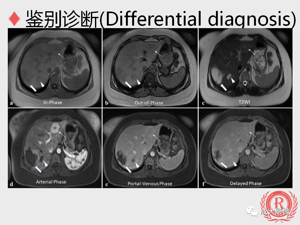 影像PPT - 【PPT】局灶性结节增生的影像表现-19