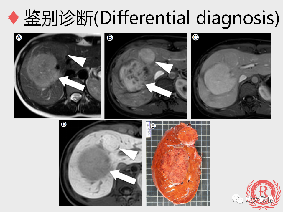 影像PPT - 【PPT】局灶性结节增生的影像表现-23