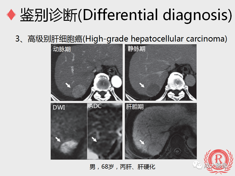 影像PPT - 【PPT】局灶性结节增生的影像表现-25