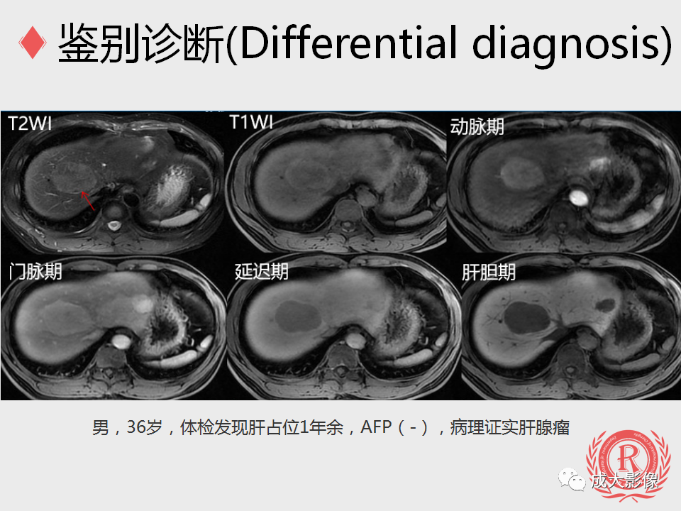 影像PPT - 【PPT】局灶性结节增生的影像表现-22