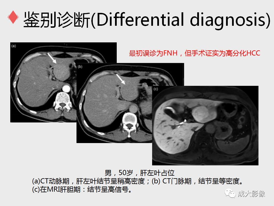 影像PPT - 【PPT】局灶性结节增生的影像表现-26