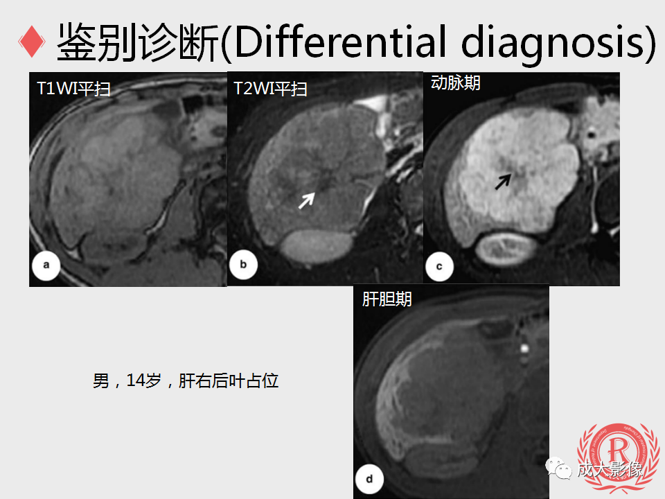 影像PPT - 【PPT】局灶性结节增生的影像表现-29