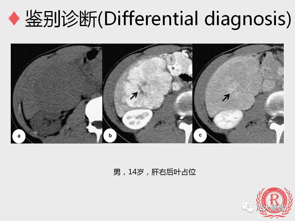 影像PPT - 【PPT】局灶性结节增生的影像表现-28