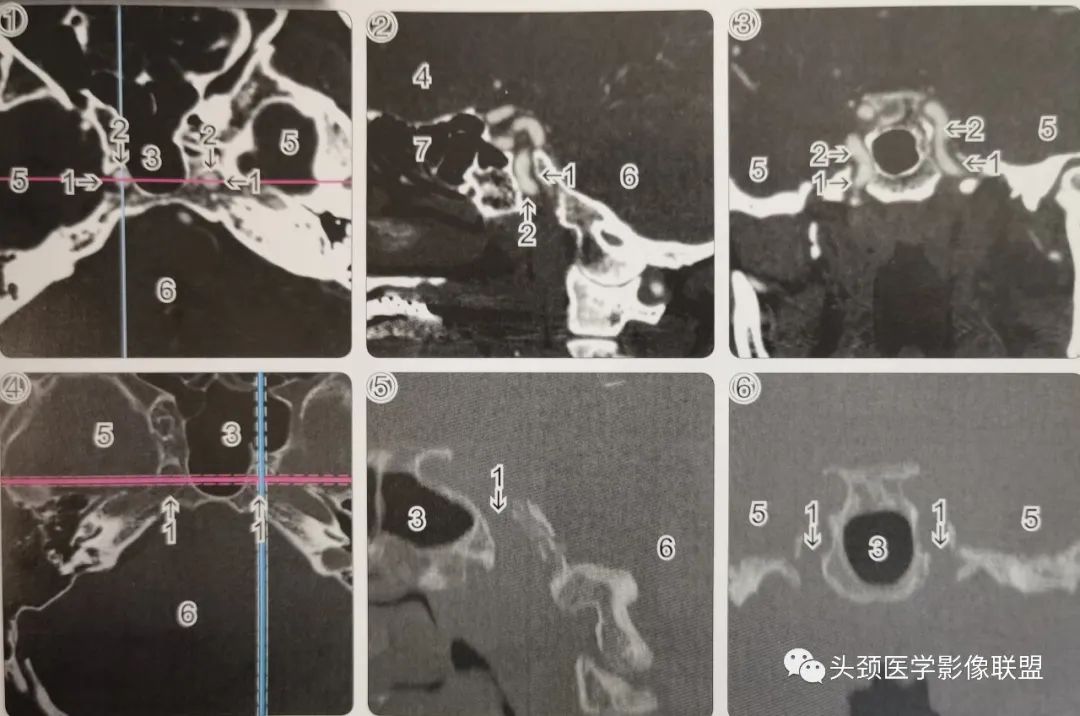 影像PPT - 破裂孔影像解剖-1 影像PPT - 破裂孔影像解剖-1