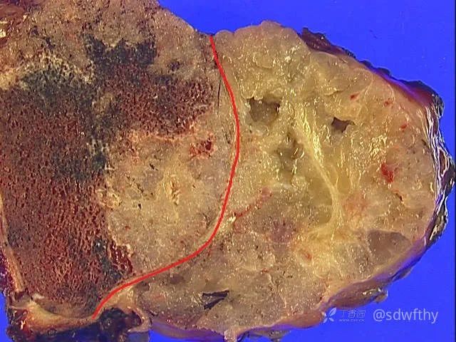 影像PPT - 软骨肉瘤病理影像对照-1 影像PPT - 软骨肉瘤病理影像对照-1
