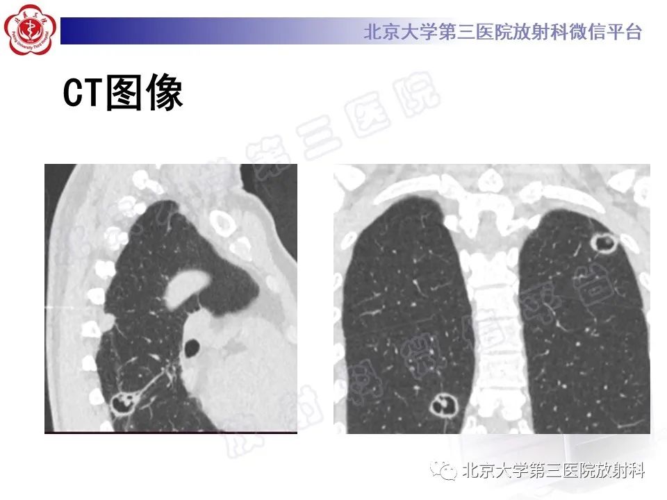 影像PPT - 【PPT】肺类风湿结节-5