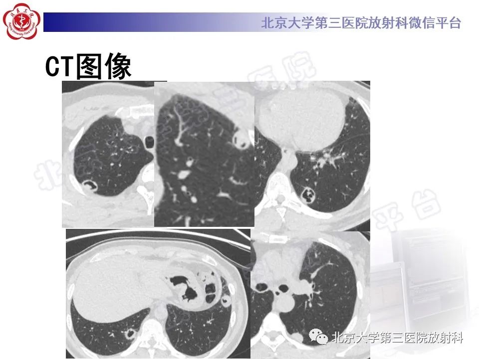 影像PPT - 【PPT】肺类风湿结节-3