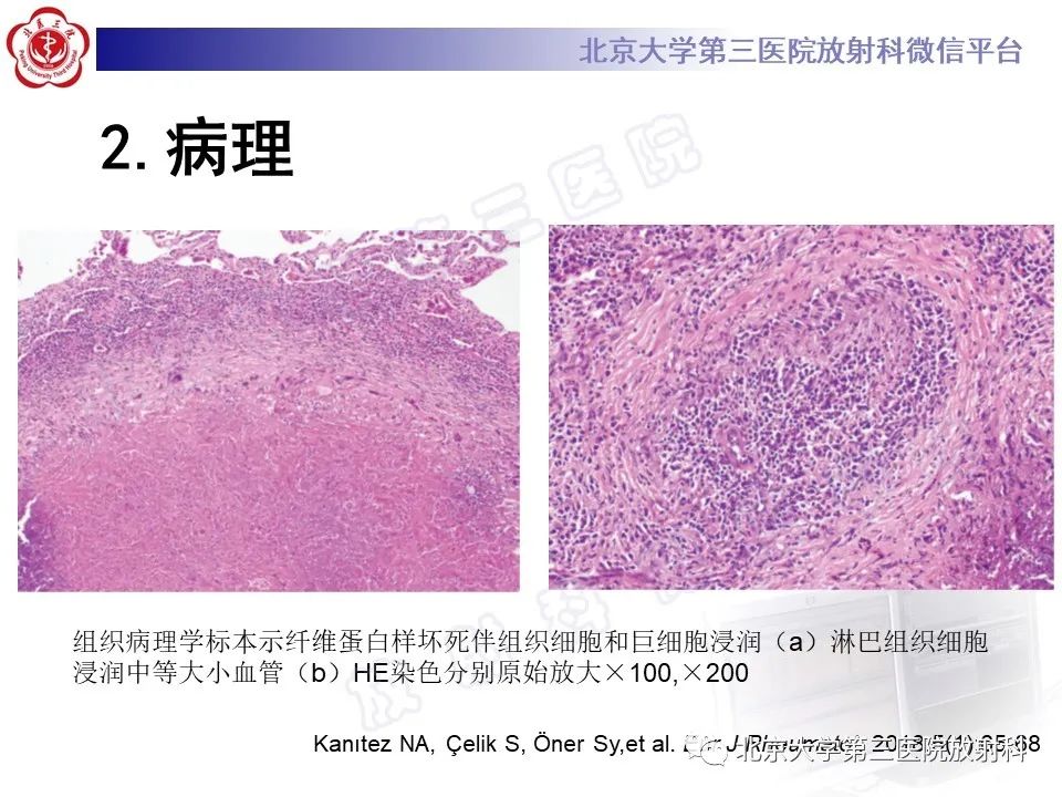 影像PPT - 【PPT】肺类风湿结节-12