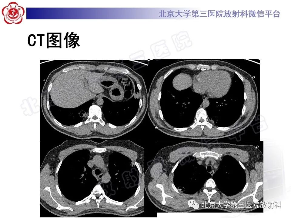 影像PPT - 【PPT】肺类风湿结节-4
