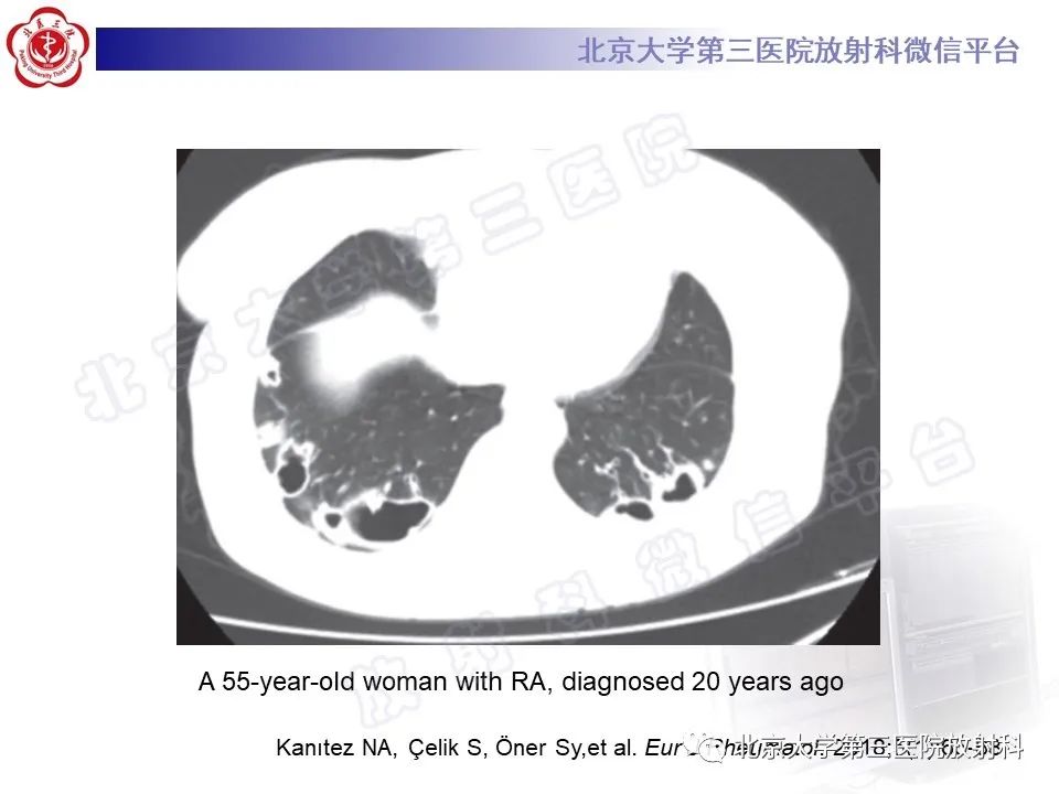 影像PPT - 【PPT】肺类风湿结节-15