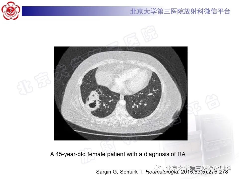 影像PPT - 【PPT】肺类风湿结节-17