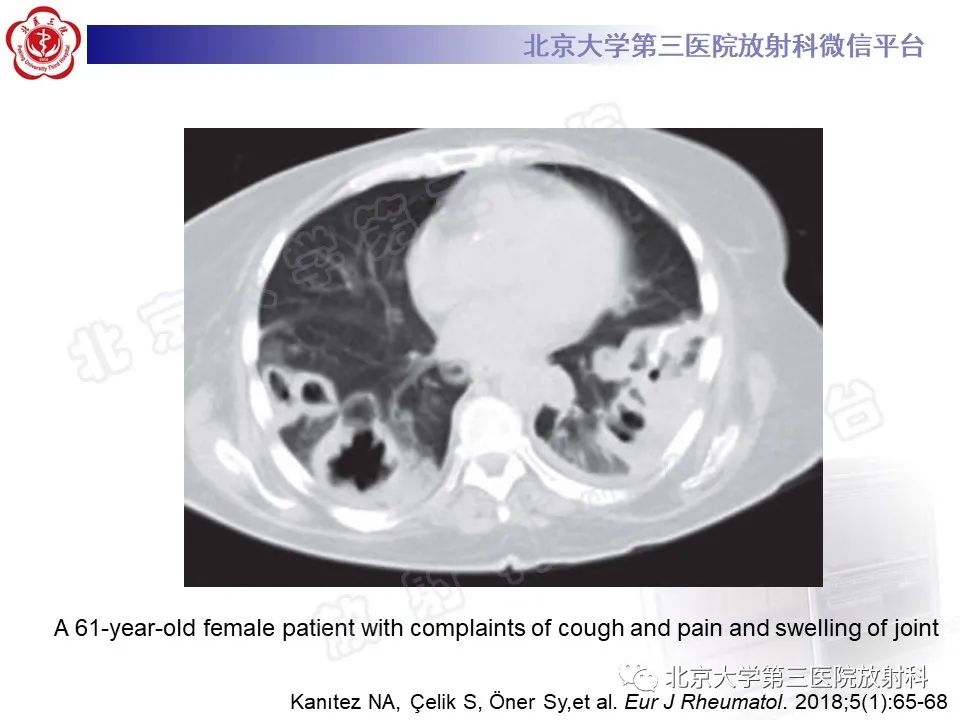 影像PPT - 【PPT】肺类风湿结节-16
