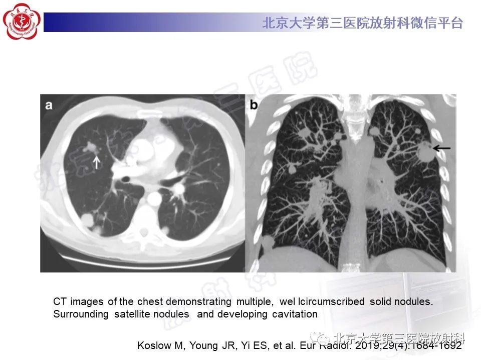 影像PPT - 【PPT】肺类风湿结节-18