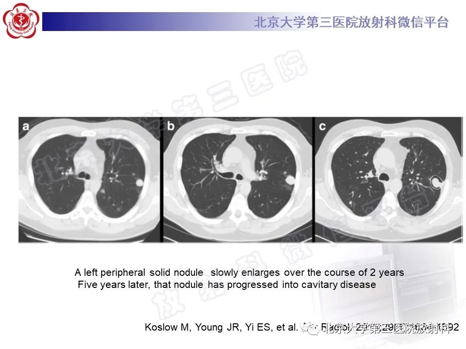 影像PPT - 【PPT】肺类风湿结节-20