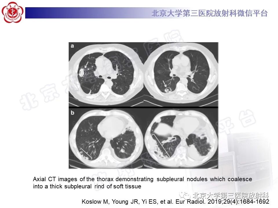 影像PPT - 【PPT】肺类风湿结节-19