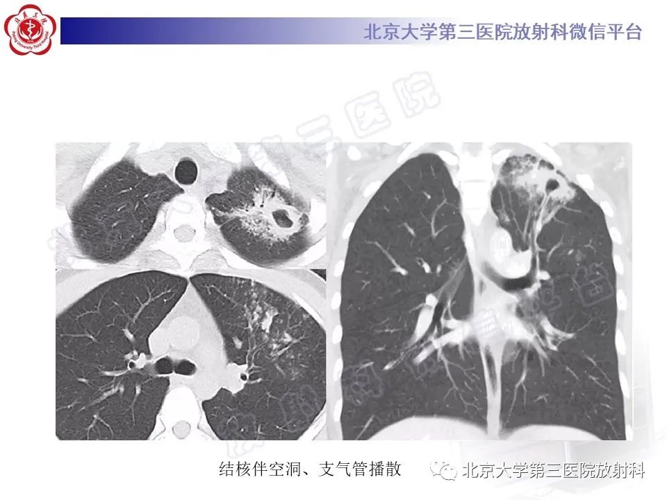 影像PPT - 【PPT】肺类风湿结节-27