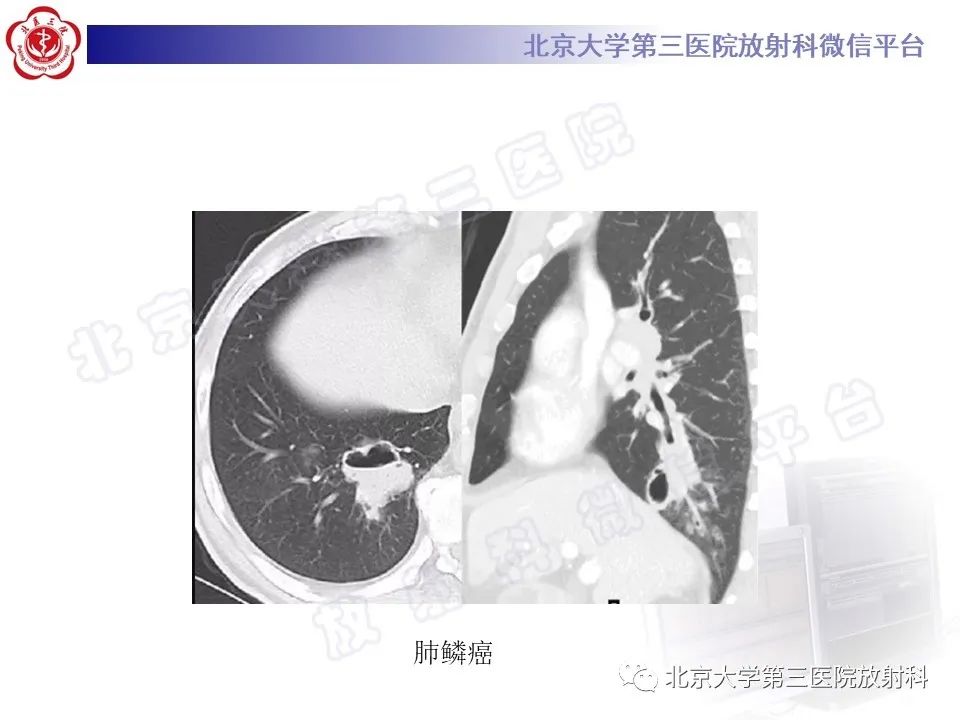 影像PPT - 【PPT】肺类风湿结节-25