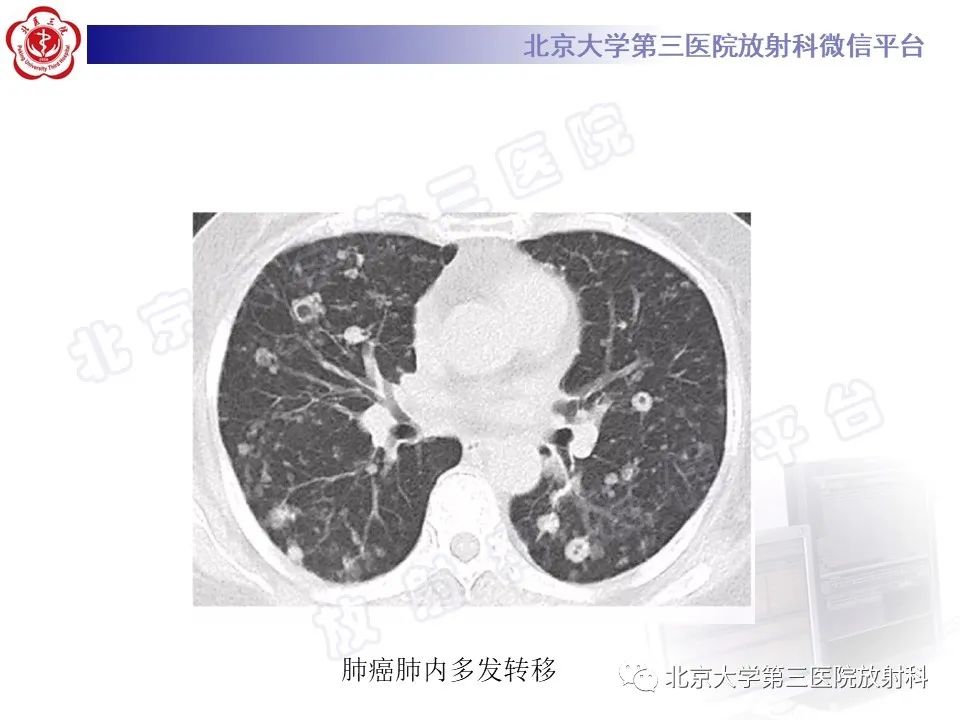影像PPT - 【PPT】肺类风湿结节-29