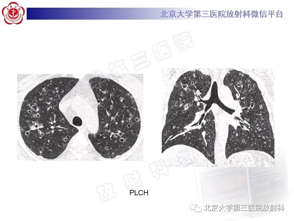 影像PPT - 【PPT】肺类风湿结节-33