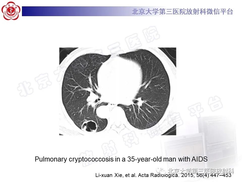 影像PPT - 【PPT】肺类风湿结节-23