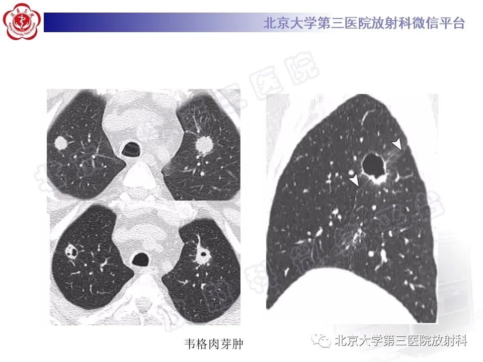影像PPT - 【PPT】肺类风湿结节-31