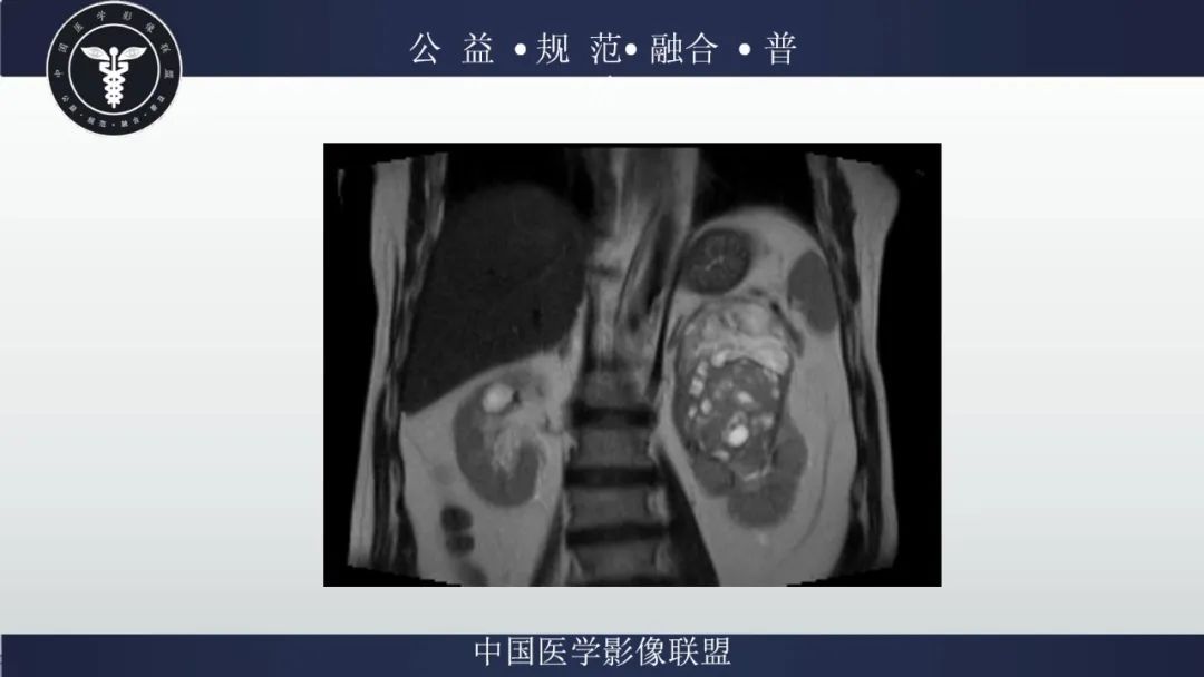 影像PPT - 【病例】肾脏嗜酸细胞瘤1例CT及MR-5