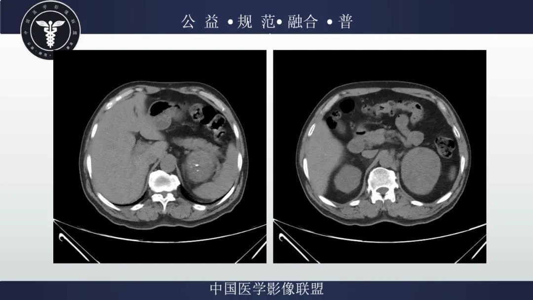 影像PPT - 【病例】肾脏嗜酸细胞瘤1例CT及MR-3