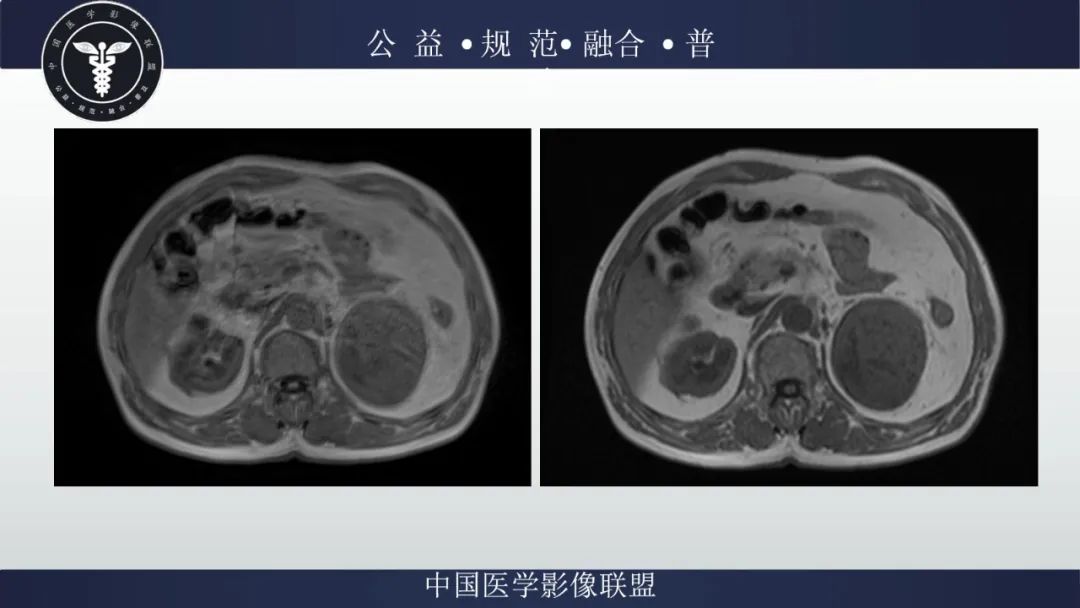 影像PPT - 【病例】肾脏嗜酸细胞瘤1例CT及MR-6
