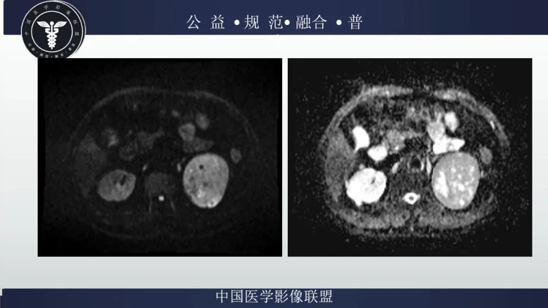 影像PPT - 【病例】肾脏嗜酸细胞瘤1例CT及MR-8