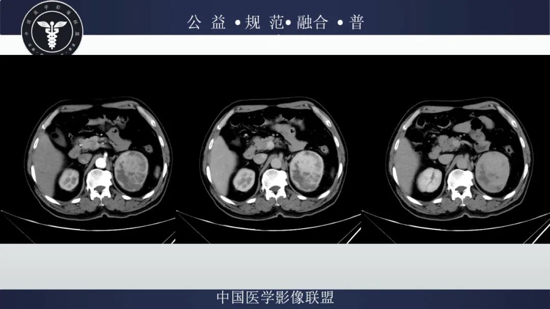影像PPT - 【病例】肾脏嗜酸细胞瘤1例CT及MR-4