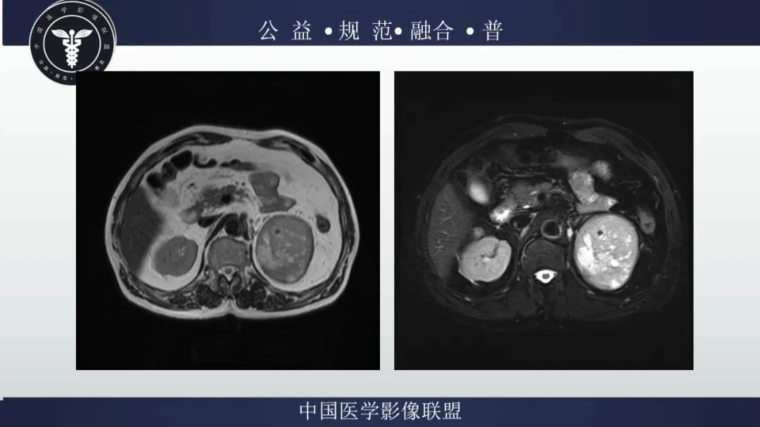 影像PPT - 【病例】肾脏嗜酸细胞瘤1例CT及MR-7
