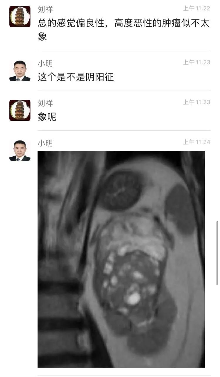 影像PPT - 【病例】肾脏嗜酸细胞瘤1例CT及MR-14