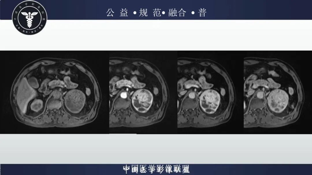 影像PPT - 【病例】肾脏嗜酸细胞瘤1例CT及MR-9