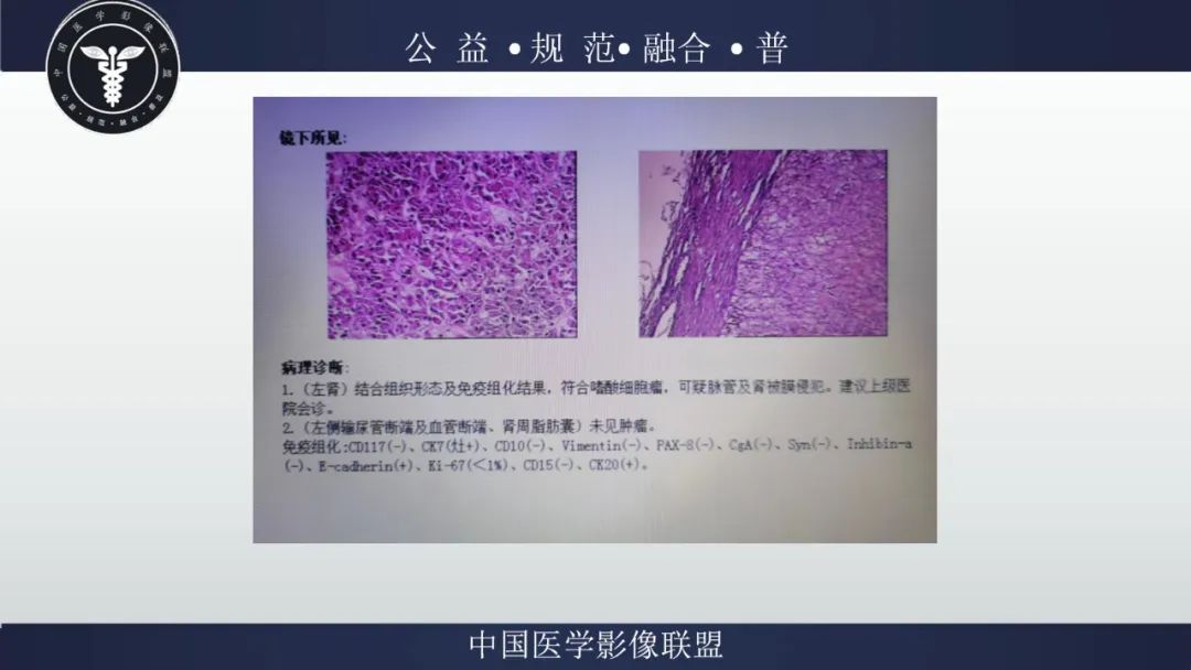 影像PPT - 【病例】肾脏嗜酸细胞瘤1例CT及MR-17