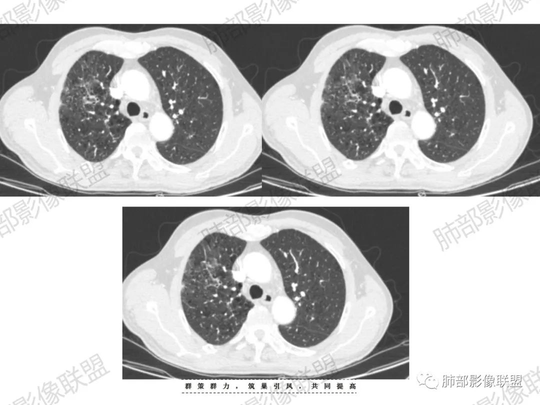 影像PPT - 【病例】宝塔样或葫芦样多结节聚合征—原发性肺肉瘤样癌1例CT-16 影像PPT - 【病例】宝塔样或葫芦样多结节聚合征—原发性肺肉瘤样癌1例CT-16