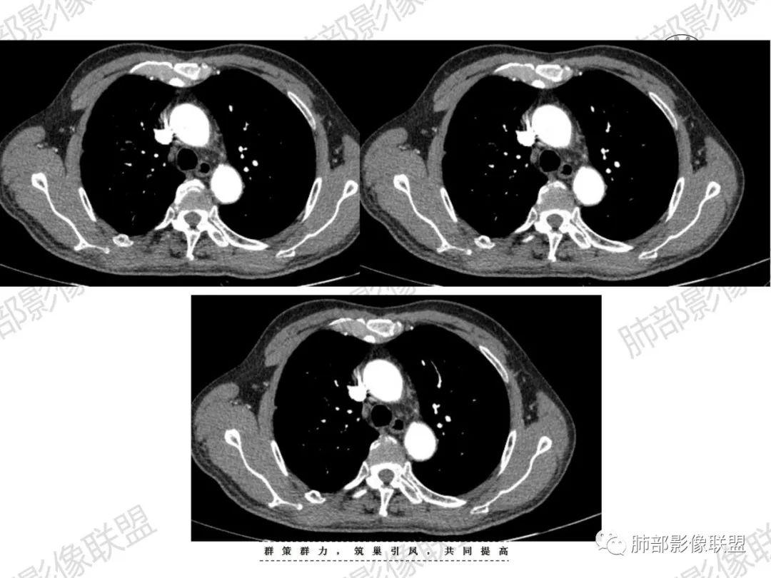 影像PPT - 【病例】宝塔样或葫芦样多结节聚合征—原发性肺肉瘤样癌1例CT-30 影像PPT - 【病例】宝塔样或葫芦样多结节聚合征—原发性肺肉瘤样癌1例CT-30