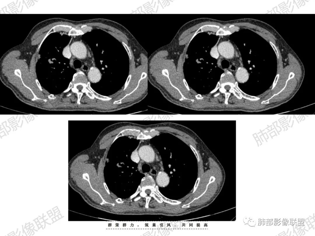 影像PPT - 【病例】宝塔样或葫芦样多结节聚合征—原发性肺肉瘤样癌1例CT-44 影像PPT - 【病例】宝塔样或葫芦样多结节聚合征—原发性肺肉瘤样癌1例CT-44