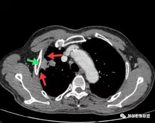 影像PPT - 【病例】宝塔样或葫芦样多结节聚合征—原发性肺肉瘤样癌1例CT-52 影像PPT - 【病例】宝塔样或葫芦样多结节聚合征—原发性肺肉瘤样癌1例CT-52