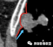 影像PPT - 【病例】宝塔样或葫芦样多结节聚合征—原发性肺肉瘤样癌1例CT-54 影像PPT - 【病例】宝塔样或葫芦样多结节聚合征—原发性肺肉瘤样癌1例CT-54