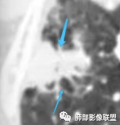 影像PPT - 【病例】宝塔样或葫芦样多结节聚合征—原发性肺肉瘤样癌1例CT-51 影像PPT - 【病例】宝塔样或葫芦样多结节聚合征—原发性肺肉瘤样癌1例CT-51