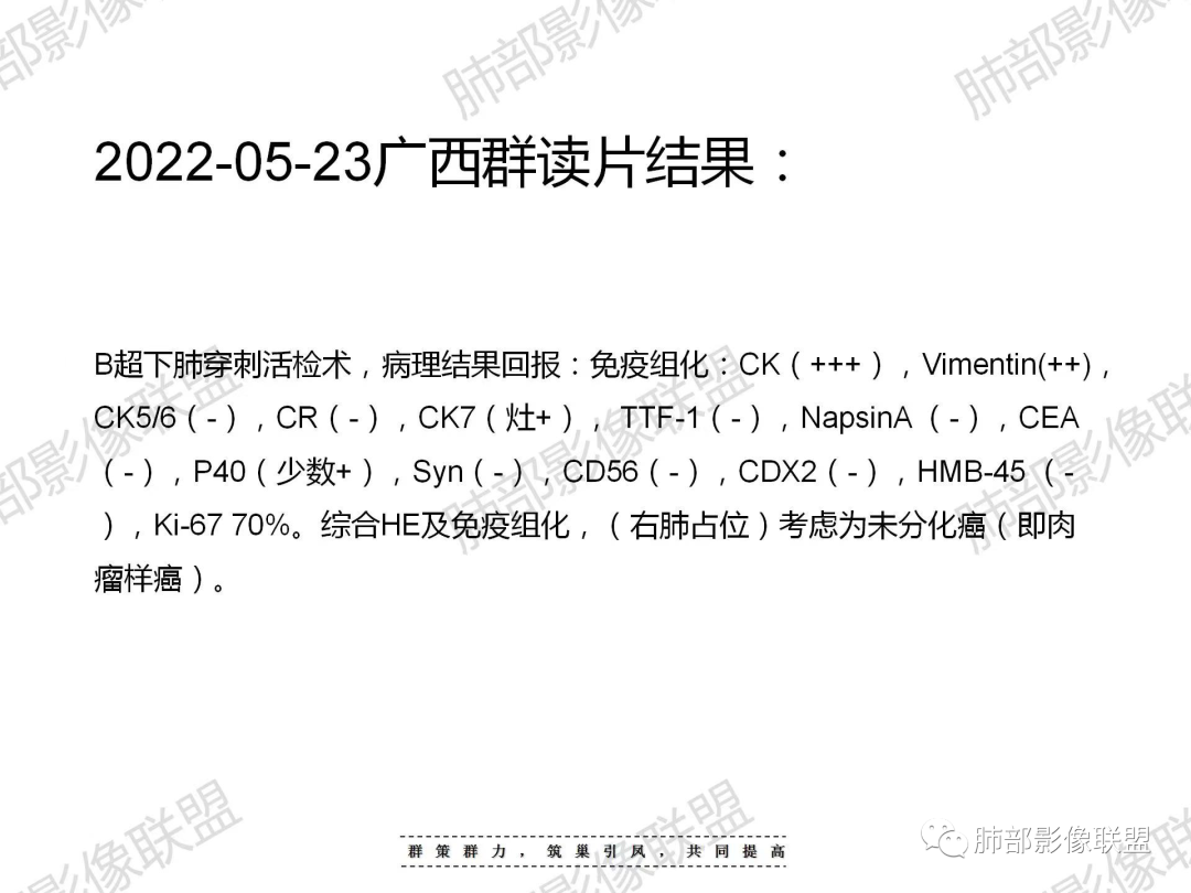 影像PPT - 【病例】宝塔样或葫芦样多结节聚合征—原发性肺肉瘤样癌1例CT-78 影像PPT - 【病例】宝塔样或葫芦样多结节聚合征—原发性肺肉瘤样癌1例CT-78