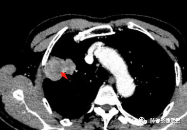 影像PPT - 【病例】宝塔样或葫芦样多结节聚合征—原发性肺肉瘤样癌1例CT-75 影像PPT - 【病例】宝塔样或葫芦样多结节聚合征—原发性肺肉瘤样癌1例CT-75