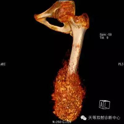 影像PPT - 【病例】骨肉瘤2例影像学表现-6 影像PPT - 【病例】骨肉瘤2例影像学表现-6
